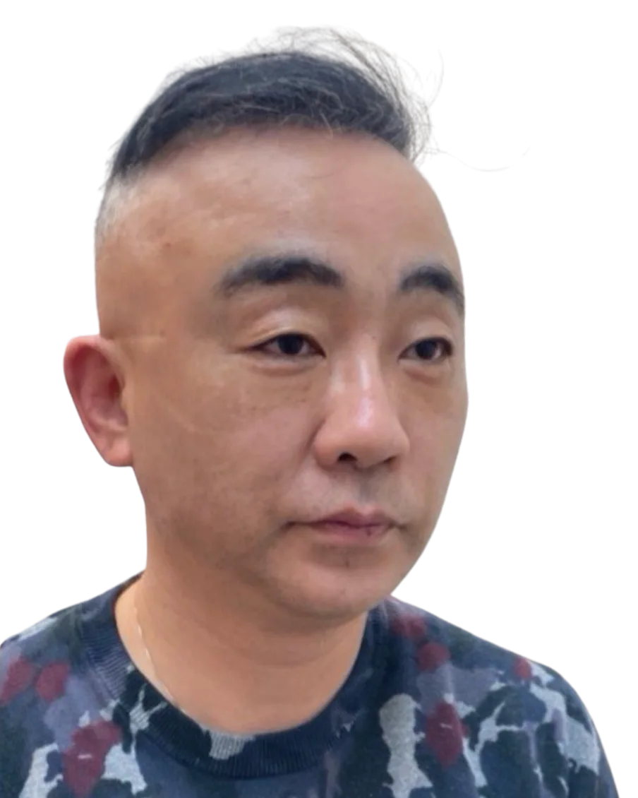 Tear Trough — After Treatment · Case 4 · Luowei Medical Aesthetics Clinic