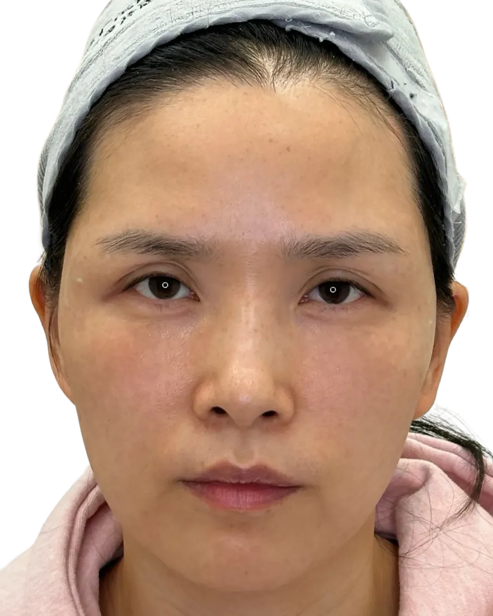 Tear Trough · After Treatment · Case 5 · Luowei Medical Aesthetics Clinic