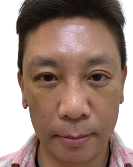 Tear Trough After Treatment · Case 6 · Luowei Medical Aesthetics Clinic