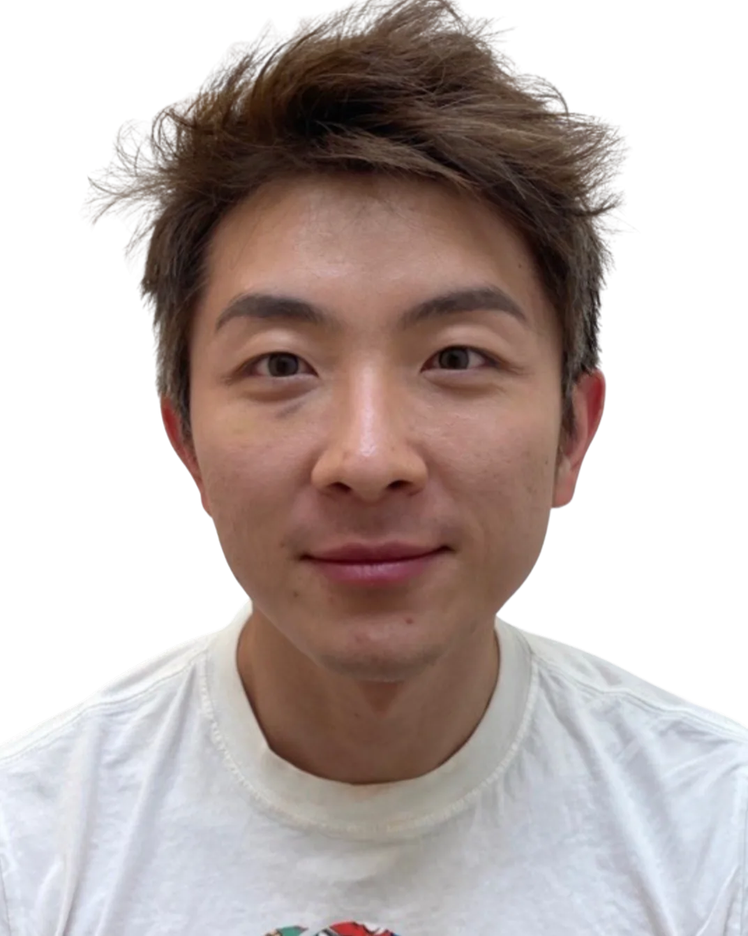 Tear Trough After Treatment · Case 7 · Luowei Medical Aesthetics Clinic