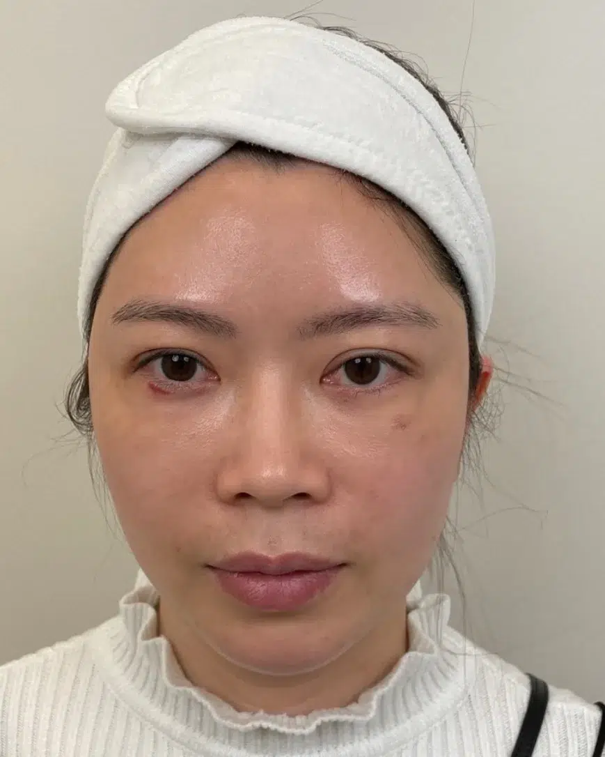 Tear Troughs — After · Case 3 · Luowei Medical Aesthetics Clinic