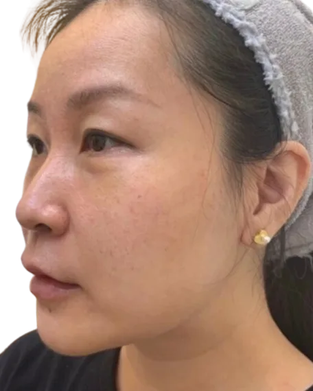 Periorbital Dark Circles — Before Treatment · Case 01 · Luowei Medical Aesthetics Clinic