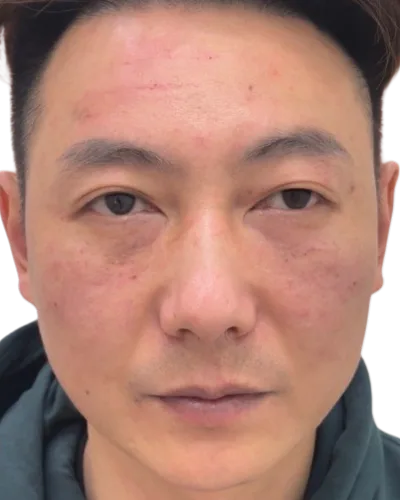 Tear Trough Before Treatment · Case 2 · Luowei Medical Aesthetics Clinic