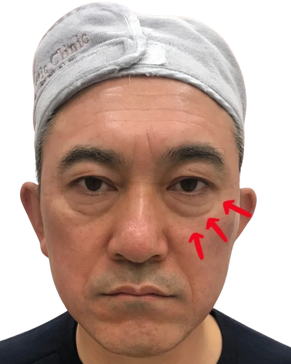 Tear Trough Before Treatment · Case 3 · Luowei Medical Aesthetics Clinic