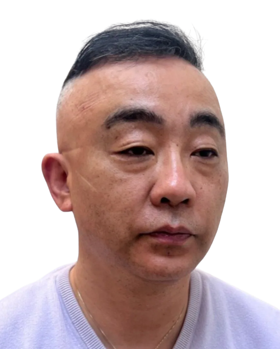 Tear Trough — Before Treatment · Case 4 · Luowei Medical Aesthetics Clinic