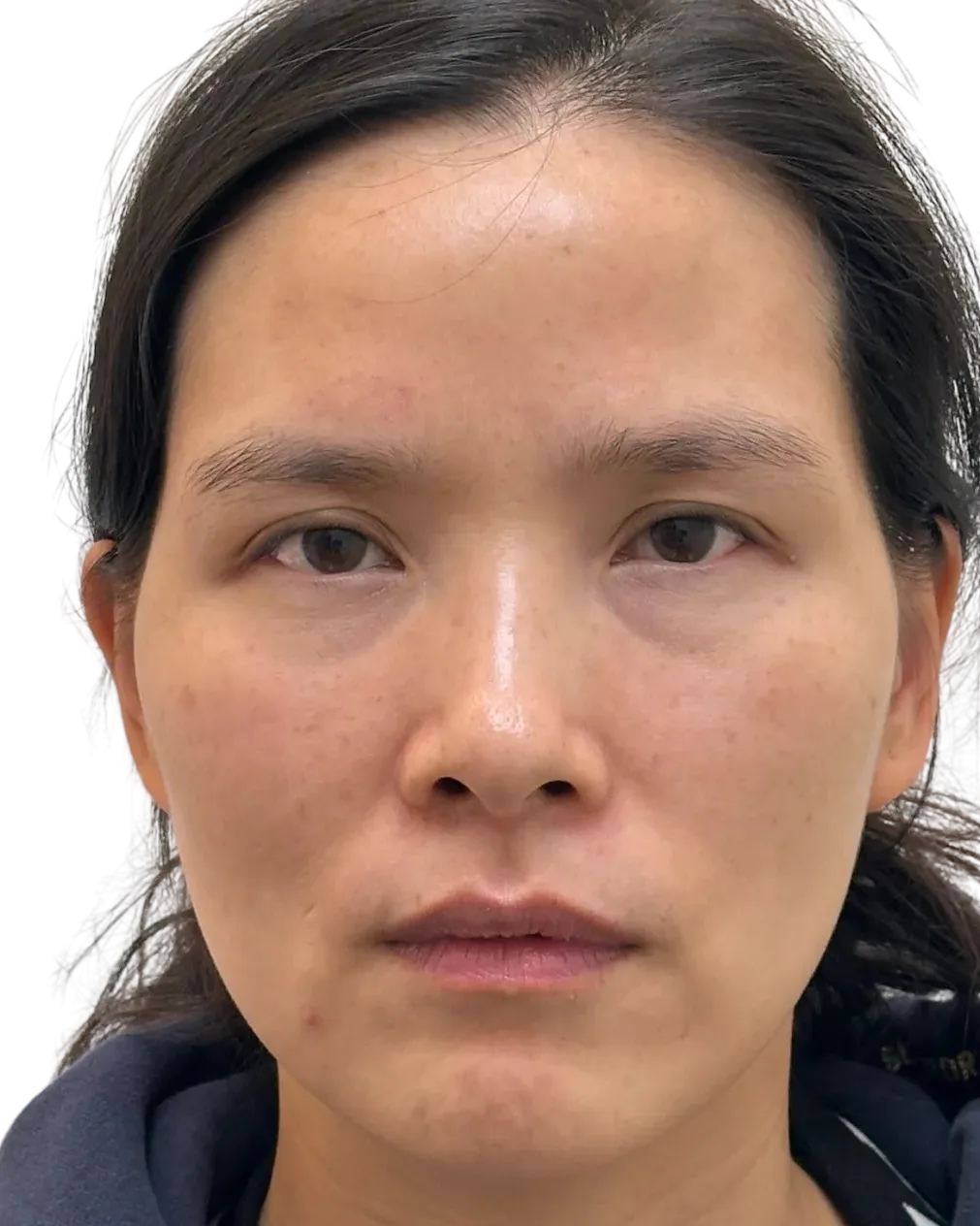 Tear Trough · Before Treatment · Case 5 · Luowei Medical Aesthetics Clinic