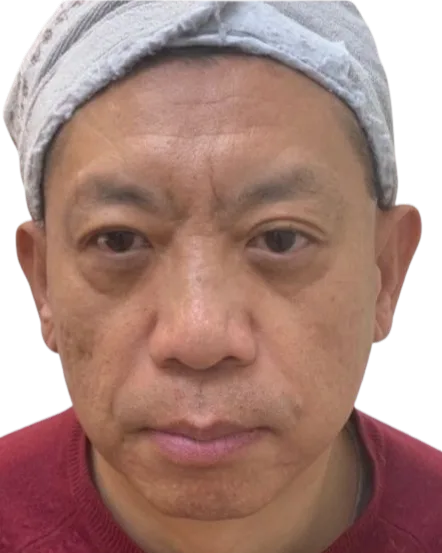Tear Trough Before Treatment · Case 6 · Luowei Medical Aesthetics Clinic