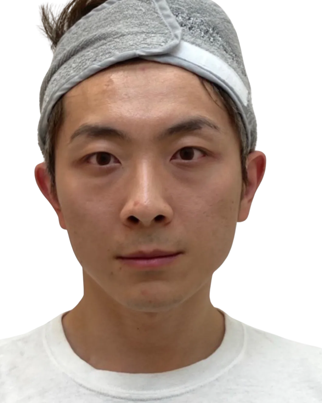 Tear Trough Before Treatment · Case 7 · Luowei Medical Aesthetics Clinic