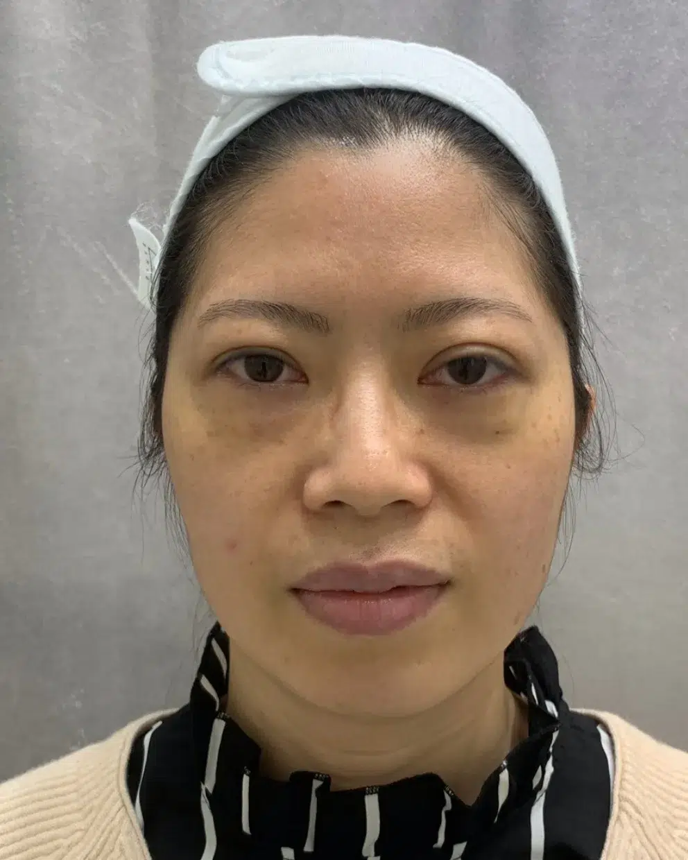 Tear Trough Before Treatment · Case 3 · Luowei Medical Aesthetics Clinic