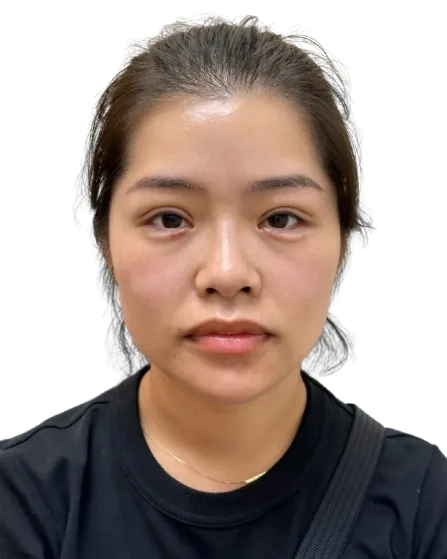 Ptosis (upper eyelid droop) — After · Case 13 · Luowei Medical Aesthetics Clinic