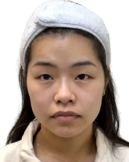 Ptosis (upper eyelid droop) — Before · Case 13 · Luowei Medical Aesthetics Clinic