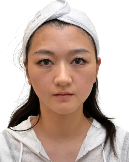 Upper eyelid ptosis — before treatment · Case 14 · Luowei Medical Aesthetics Clinic