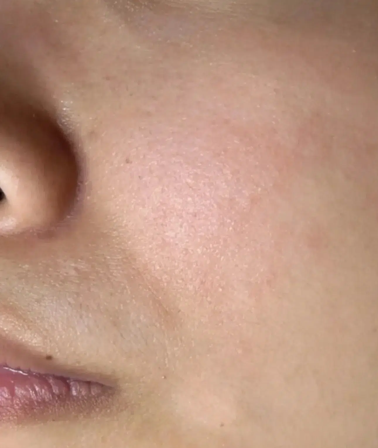 Treating Uneven Skin Tone — Before Treatment · Case 8 · Luowei Medical Aesthetics Clinic