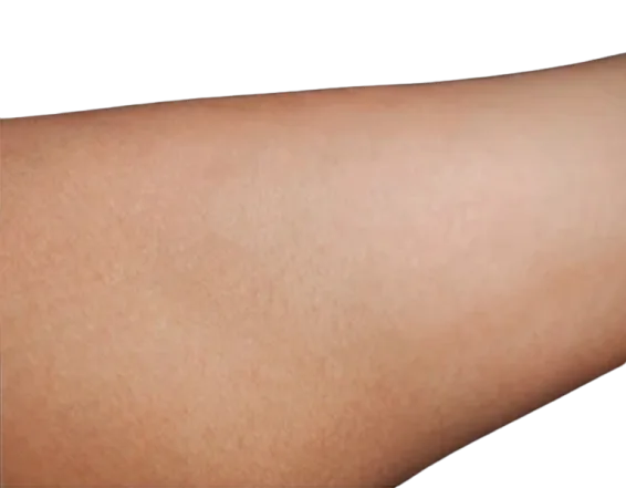 Laser Hair Removal for Unwanted Hair Before & After · Multi-Device Protocol · Luowei Medical Aesthetics Clinic Nanjing · Case 1