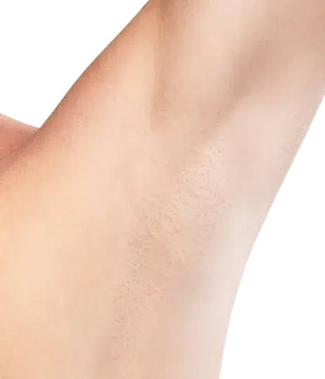Laser Hair Removal on Darker Skin Before & After · Nd:YAG Deep-Penetration Protocol · Luowei Medical Aesthetics Clinic Nanjing · Case 3