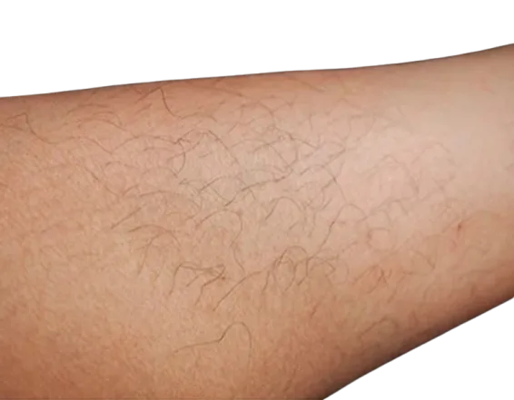 Laser hair removal before & after for unwanted hair · Multi-device protocol · Luowei Medical Aesthetics Clinic Nanjing · Case 1