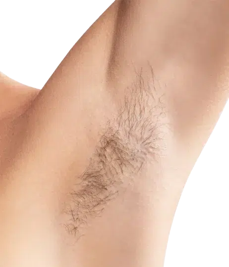 Laser hair removal before & after on deeper skin tone · Nd:YAG deep-penetration protocol · Luowei Medical Aesthetics Clinic Nanjing · Case 3
