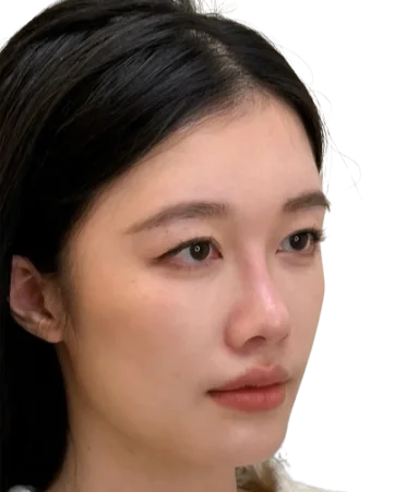 Volume Loss — After Treatment · Case 05 · Luowei Medical Aesthetics Clinic