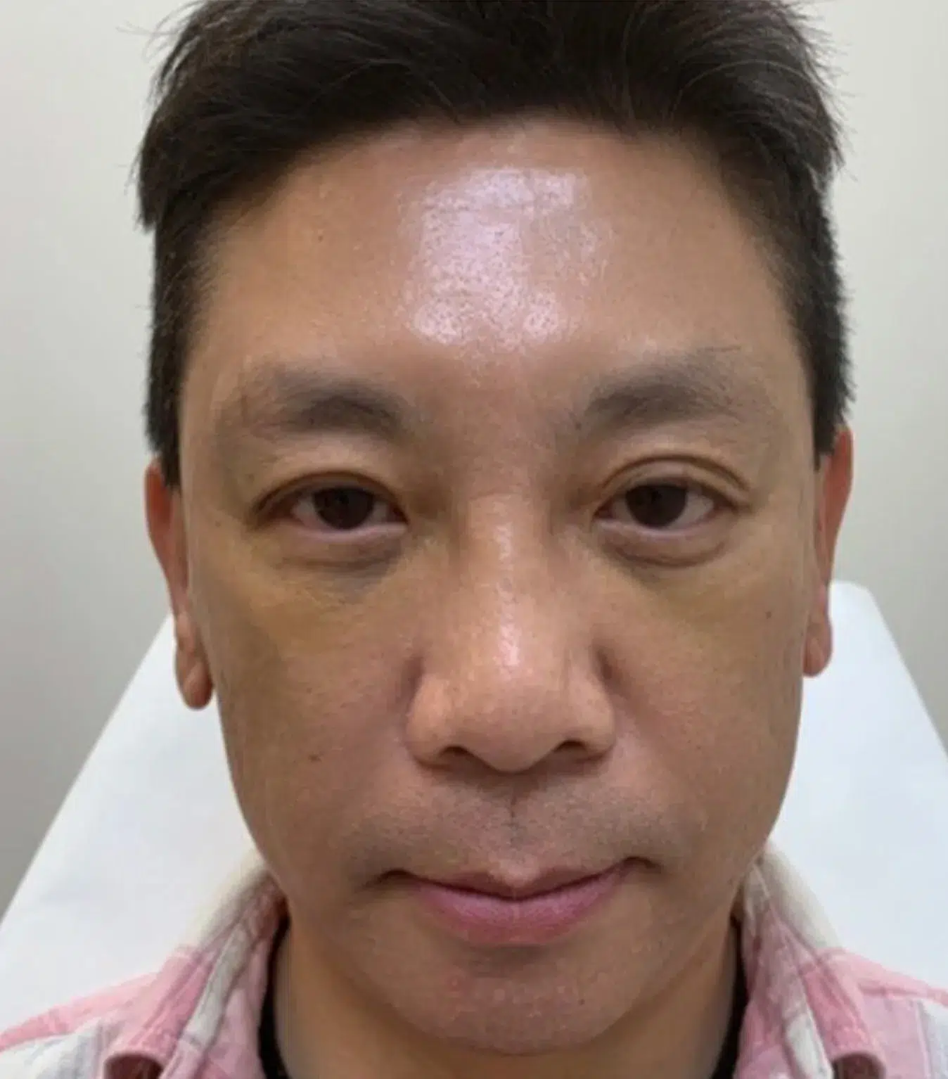 Hyperpigmentation After · Case 06 · Luowei Medical Aesthetics Clinic