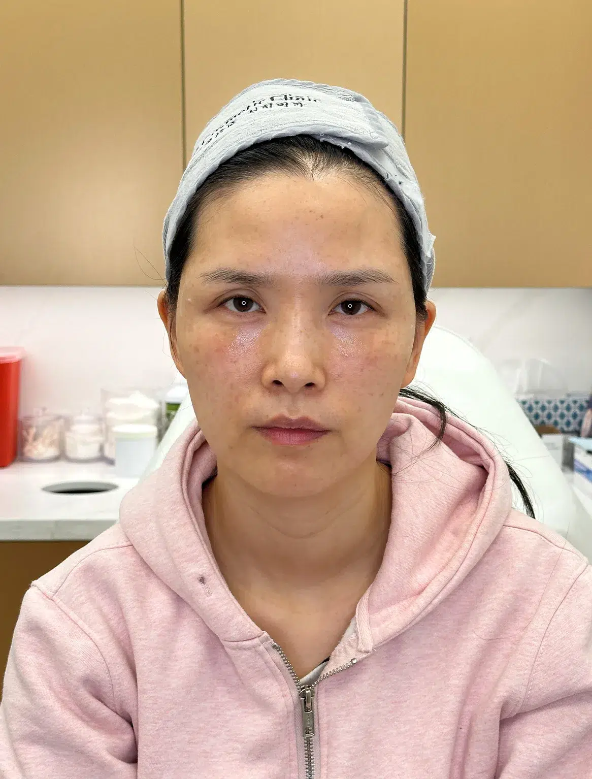 Ptosis (upper eyelid droop) — After · Case 07 · Luowei Medical Aesthetics Clinic