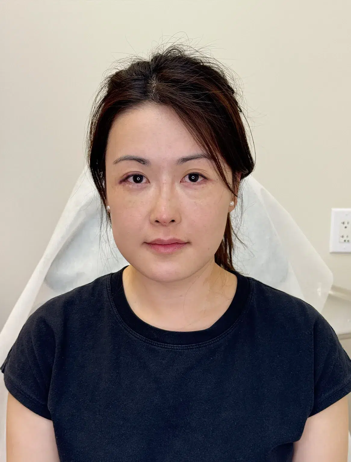 Volume Loss — After Treatment · Case 17 · Luowei Medical Aesthetics Clinic