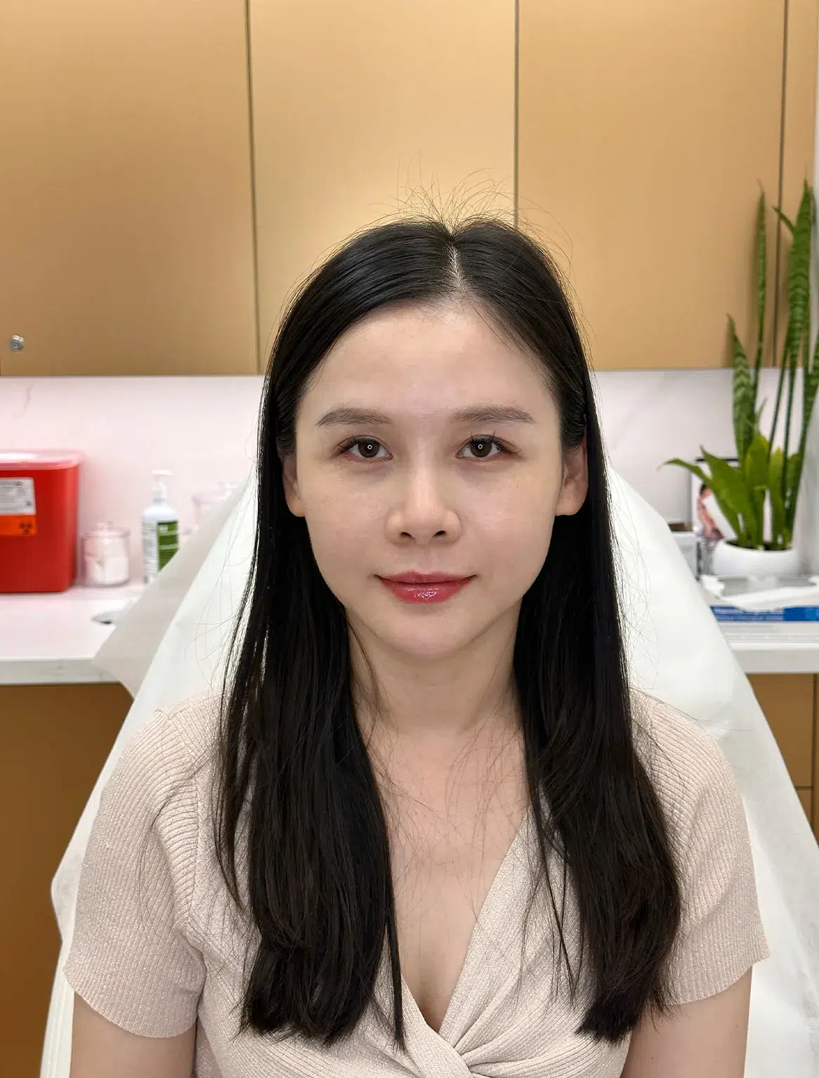 Volume Loss — After Treatment · Case 20 · Luowei Medical Aesthetics Clinic