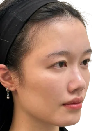 Volume Loss — Before Treatment · Case 05 · Luowei Medical Aesthetics Clinic