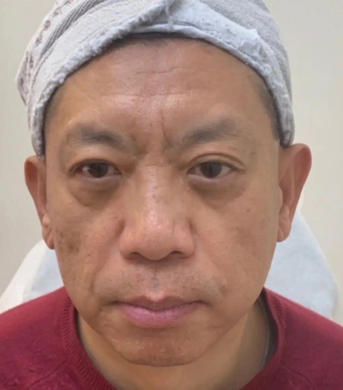 Hyperpigmentation Before · Case 06 · Luowei Medical Aesthetics Clinic