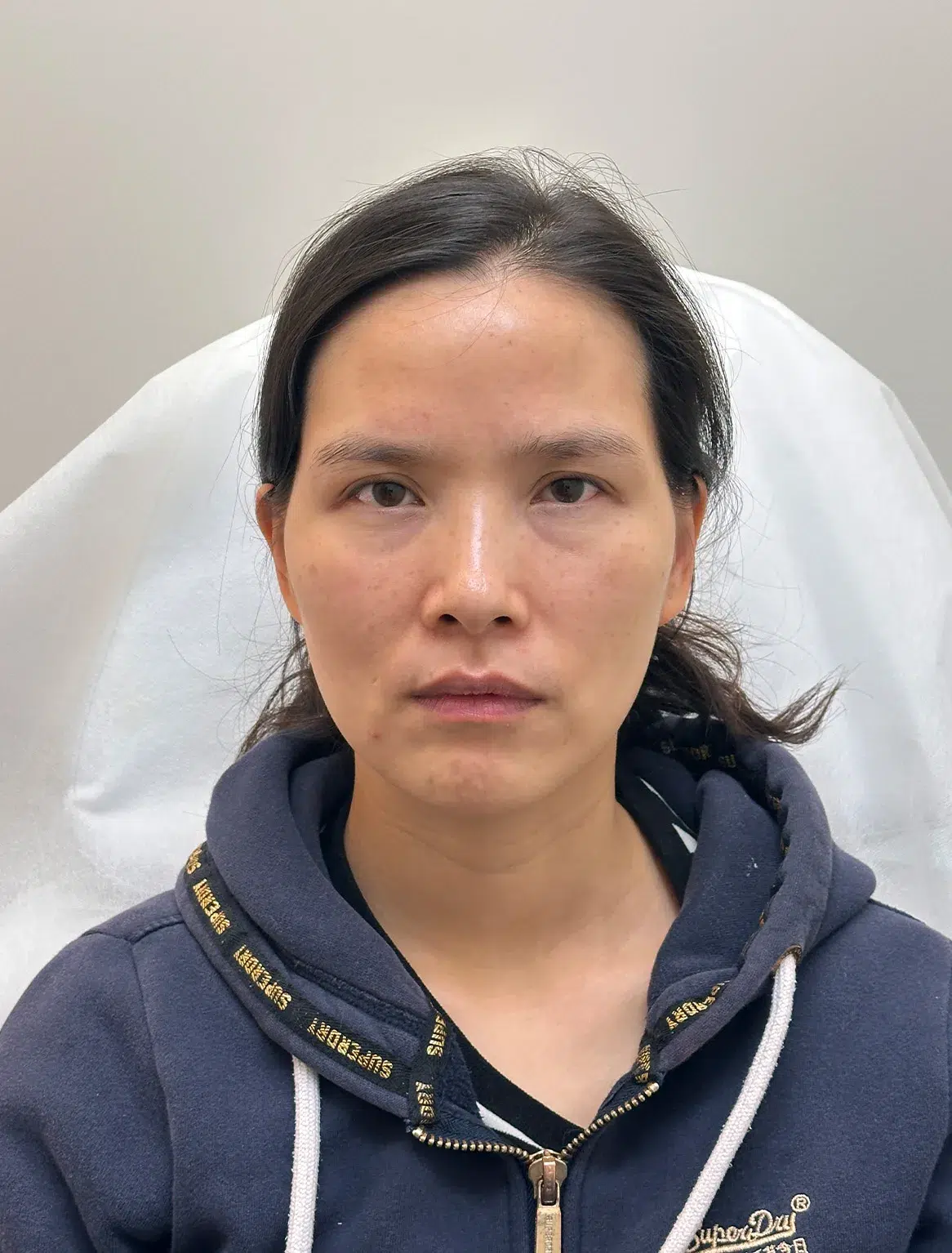 Ptosis (upper eyelid droop) — Before · Case 07 · Luowei Medical Aesthetics Clinic