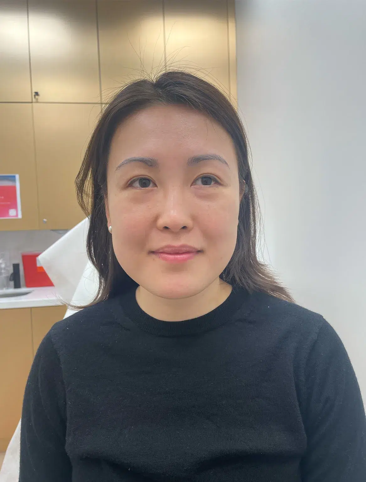 Volume Loss — Before Treatment · Case 17 · Luowei Medical Aesthetics Clinic