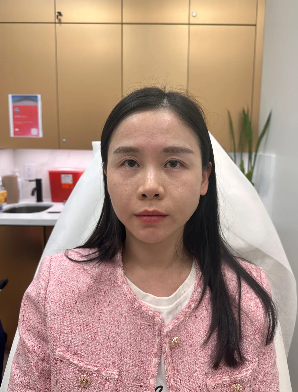 Volume Loss — Before Treatment · Case 20 · Luowei Medical Aesthetics Clinic