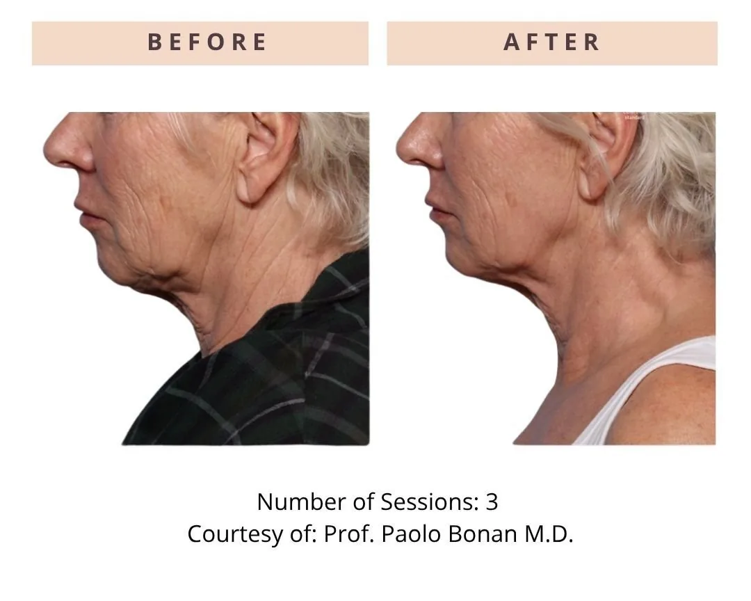 ONDA PRO — CoolWaves double chin before and after, clinical case